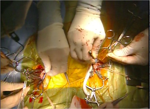 Anatomical femoro-femoral crossover bypass after left axillo-left femoral bypass. Ax-F & F-F bypass were performed for vascular reconstruction using poly-tertrafluoroethylene (PTFE) to maintain the blood flow to the both lower extremities