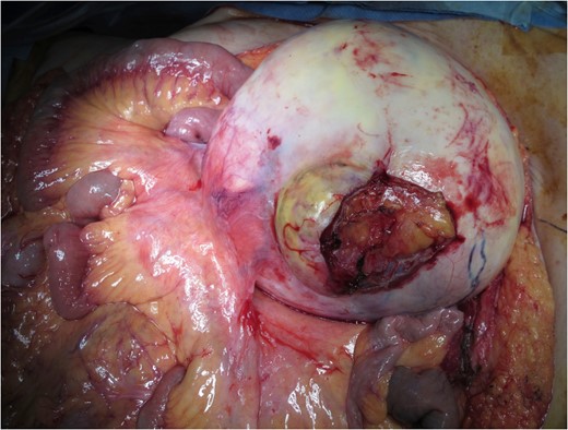 Mesenterium invasion of large retroperitoneal tumor. A huge tumor with a fibrous capsule invaded mesenterium, but SMA was free from the tumor.