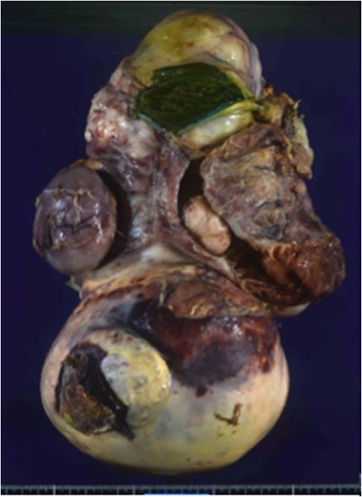 Macroscopic findings of the tumor. The resected specimen measured 33 × 20 × 13 cm3 and weighed 4800 g.