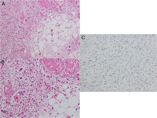 Microscopic findings of the tumor. Histopathological examination showed that the tumor was composed of a mixture of well-differentiated lipoblast and plemorphic liposarcoma with both atypical nuclear and multinuclear spindle cells. (A) Hematoxylin-eosin staining, ×10; (B) hematoxylin-eosin staining, ×20. Tumor cells were positive for MDM-2 ((C) imunohistochemistry of MDM-2, ×20). We diagnosed it as dedifferentiated liposarcoma.