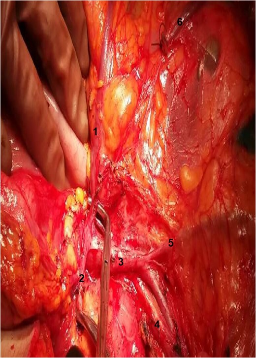 Exposure of the operative field. 1: RCA; 2: gastroepiploic artery; 3: superior mesenteric vein; 4: SMA; 5: ileocolic vein; 6: stump of right colic vein.
