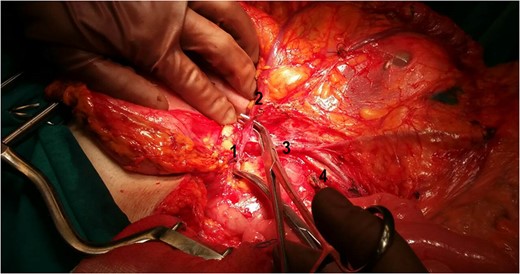 The relation between the vessels: 1: gastroepiploic artery; 2: RCA; 3: superior mesenteric vein; 4: SMA.