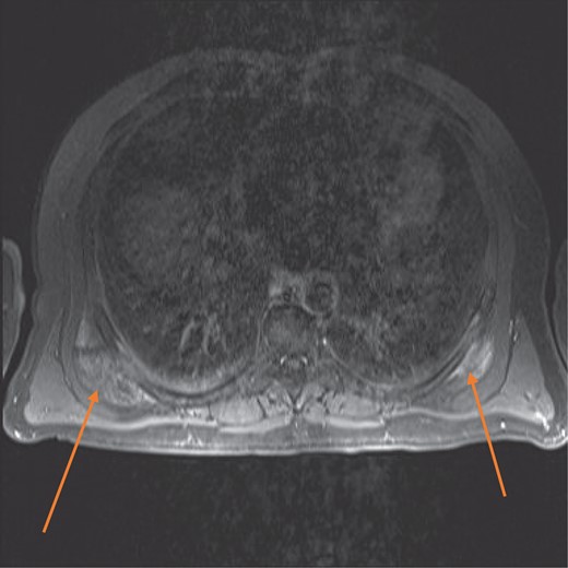 MRI axial view showing bilateral elasto fibromas (orange arrows) on the posterior rib cage.