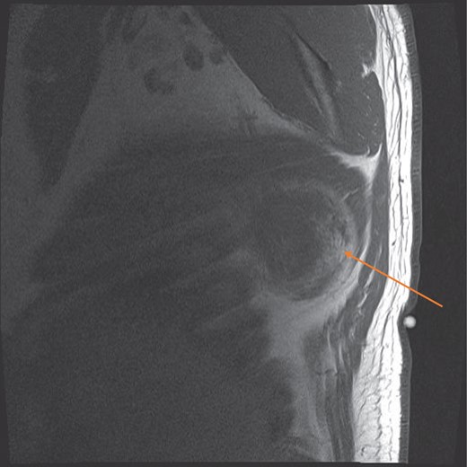 MRI sagittal view showing the circumscribed right sided tumour with a pseudocapsule, at the infrascapular region (orange arrow).