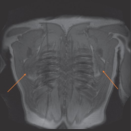 MRI coronal view of bilateral elastinfibromas (orange arrows).