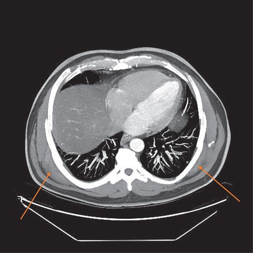 CT scan axial view showing bilateral tumours (orange arrows).