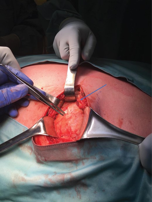 Tumour exposure(forceps) below the lattisimus dorsi (blue arrow).