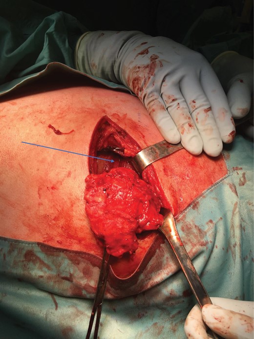 Tumour removed off the posterior rib cage (blue arrow).