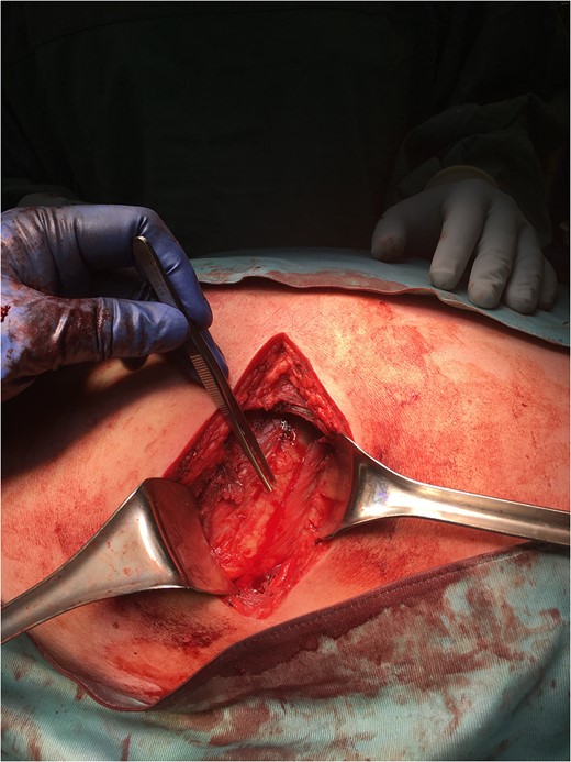 Posterior rib cage(forceps), post-tumour excision.