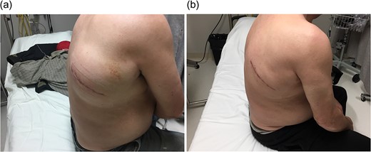 (a) Post-operative haematoma (b) Haematoma resolution with conservative management.
