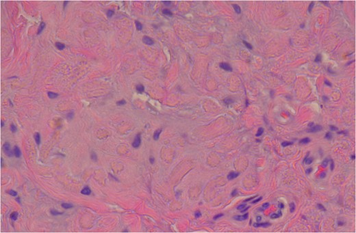 High Power slide showing elastic fibres (pink areas) which confirms the diagnosis of elastofibroma. (Altered elastic fibres in a collagenous matrix).