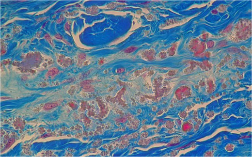 Mason’s Trichome stain outlining collagen around the abnormal elastic fibres with the characteristic serrated edges or petalloid globules. It outlines the elastic fibres by negative staining.