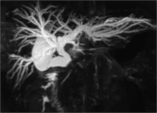 Magnetic resonance cholangiography showed the dilated intrahepatic biliary tree, the common hepatic duct and the gallbladder.