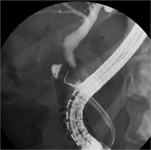 Endoscopic retrograde cholangiography demonstrated a filling defect at the confluence of the bile duct.