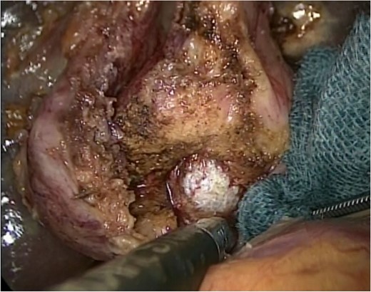 The intraoperative findings: The anterior wall of the cystic duct and the common hepatic duct was dissected to remove the gallstone.
