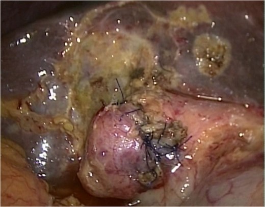 The intraoperative findings: The gallbladder patch was sutured to the dilated cystic duct and intraoperative cholangiography was performed.