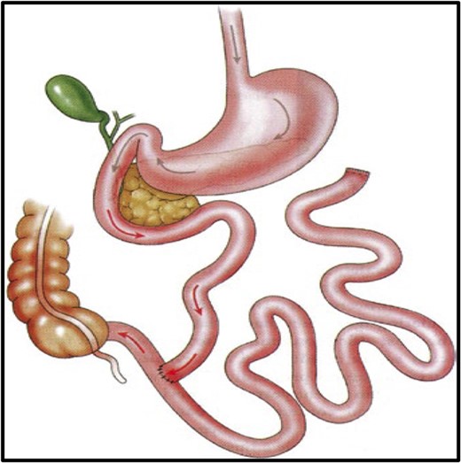 Anatomy of jejunoileal bypass.