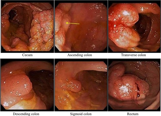 Colonoscopy: colonic polyposis.
