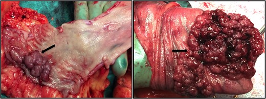 Surgical fragments from total colectomy with polyposis.