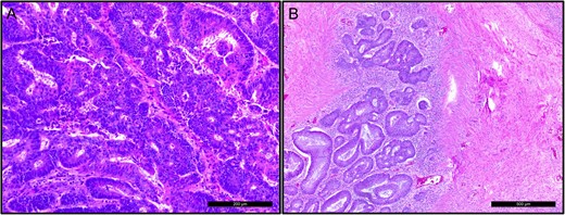 Optical microscopic view, hematoxylin & eosin staining. Fragments from polypoid lesion with adenocarcinoma. (A) Invasive adenocarcinoma, low grade. (B) Adenocarcinoma with desmoplastic reaction.