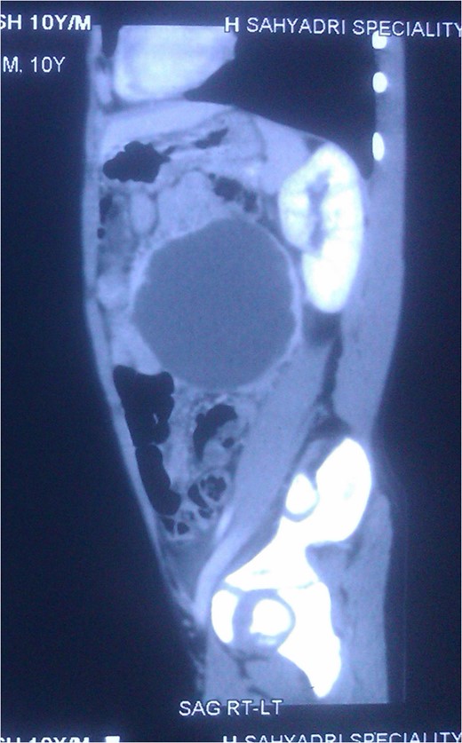 CT Scan Sagittal section showing the large splenic mass.
