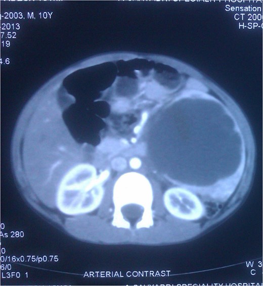 CT Scan: Cross section showing the splenic mass almost reaching the midline.