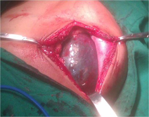 Intraoperative photo of the splenic mass showing the cystic lesion.