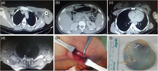 (a) CT image of the patient, (b) normal liver on CT scan, and normal size of spleen, (c) normal lung parenchyma on CT scan (d) magnetic resonance image, (e) intraoperative appearance of the cyst and (f) excised cyst.