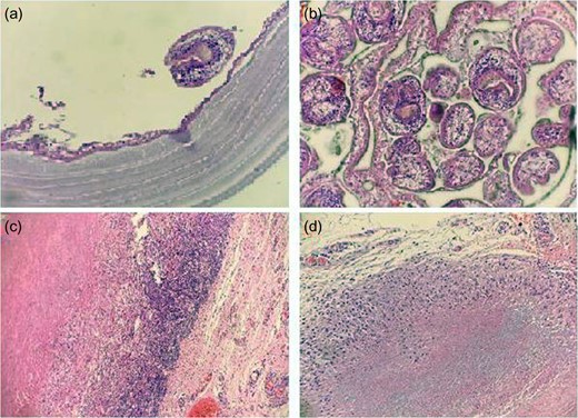 Microscopic view of sections of surgical specimen. (a) In order from bottom to top; laminated membrane, germinative membrane, and a scolex structure (H&E: ×400), (b) multipl scolices (H&E: ×400), (c) intense chronic inflammation around the cyst (H&E: ×100) and (d) granulomatous reaction around the cyst (H&E: ×200).