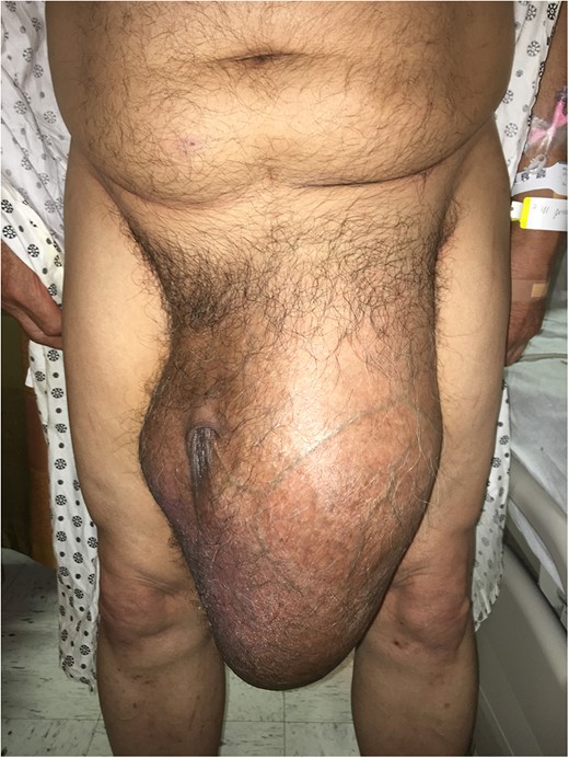 Giant left inguinoscrotal hernia.