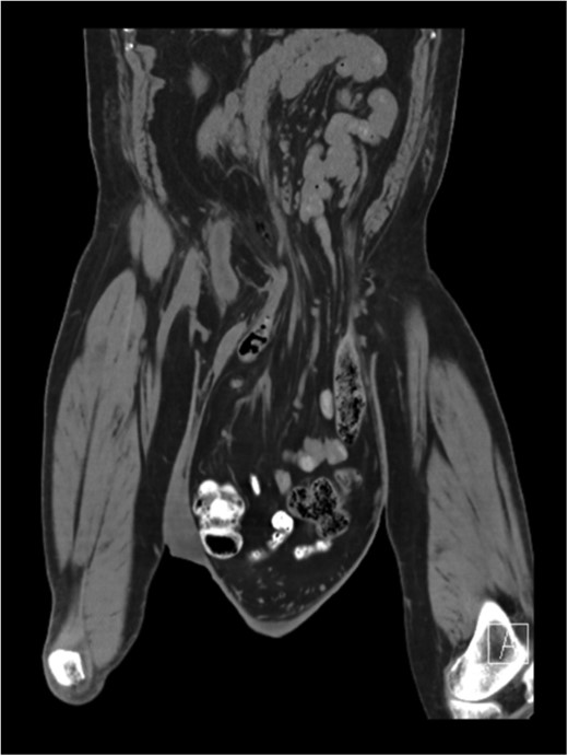 CT Scan showing small and large bowel within left scrotal sac.