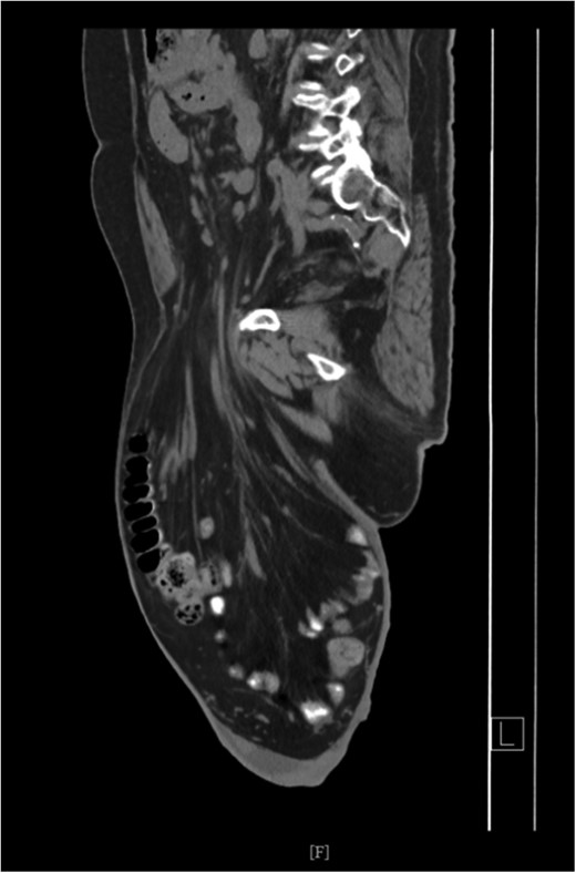 CT Scan showing mesentery, small bowel and transverse colon.