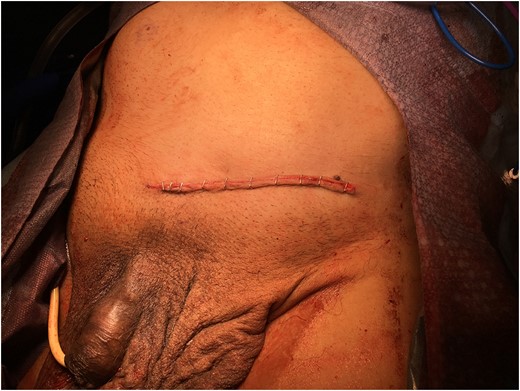 Reduction of left hernia contents within abdominal cavity. Note significant distension of the abdomen in this post-operative photograph.