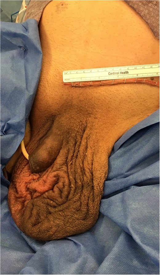 Redundant skin in the left scrotum left purposely intact should patient require decompression of abdominal contents due to increase of intra-abdominal pressure.