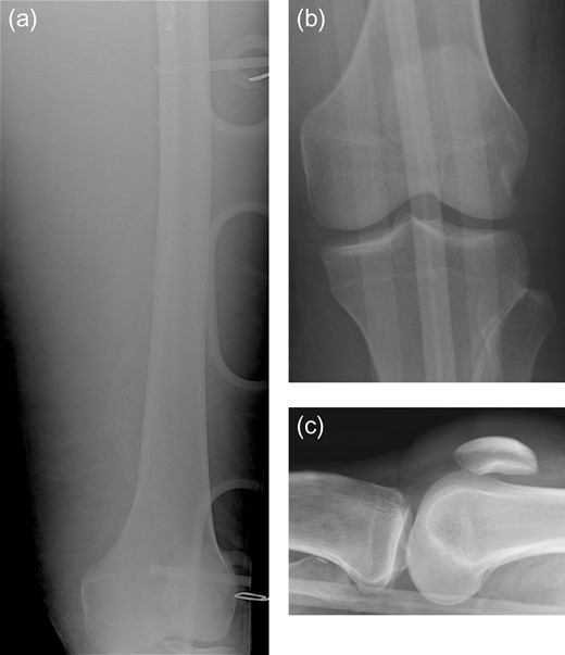 Portable frontal view of the left femur (a) obtained in the trauma bay demonstrates no evidence of acute fracture. Subsequent AP (b) and cross-table lateral (c) radiographs of the left knee demonstrate no evidence of acute fracture or dislocation.