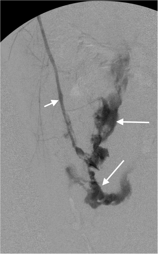 Intraoperative arteriogram of the left lower extremity demonstrates opacification of the superficial femoral artery (short arrow). There is extensive extraluminal extravasation of contrast (long arrows) from the popliteal artery, and non-visualization of the distal vessels, consistent with complete transection of the popliteal artery.