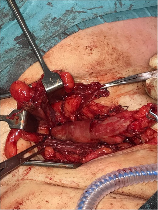 Tip of the appendix within hernial sac identified during open repair.