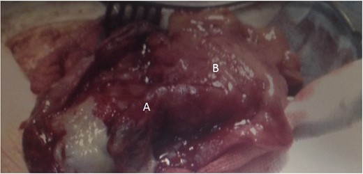 Left-sided inguinal hernia containing the VA (A) and caecum (B). Note the inflammatory changes and the gangrenous tip consistent with appendicitis.