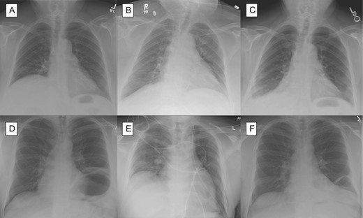 Chest X-ray for patient with right diaphragm paralysis (A) after repair on post-operative Day 1 (B) and after 1 month (C) as well as chest x-ray of patient with left diaphragm paralysis (D) after repair on post-operative Day 1 (E) and after 1 month.