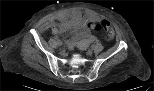 Abdominal CT scan showing right-sided RSH.