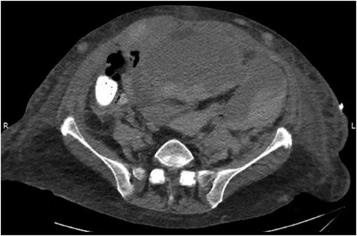 Abdominal CT scan showing the RSH extending into space of Retzius and retroperitoneum.