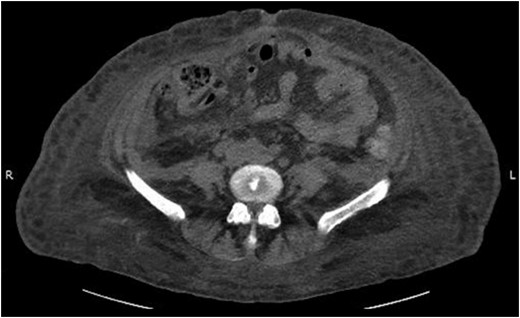 Abdominal CT scan showing complete resolution of rectus sheath and retroperitoneal hematomas.