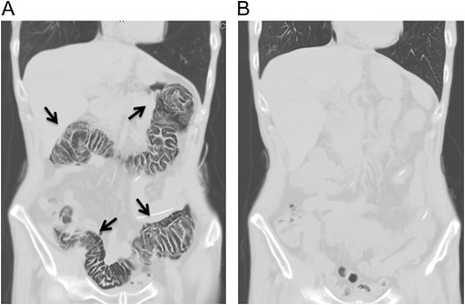 Abdominal computed tomography at the onset of abdominal pain revealed pneumatosis intestinalis of the colon. No free air was detected (A). Computed tomography 7 days after the diagnosis of pneumatosis intestinalis did not show any gas within the wall of colon (B).