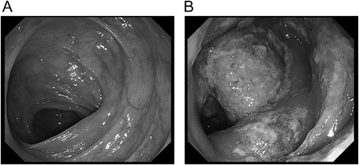 Colonoscopy at the onset of abdominal pain. In colonoscopy on the day of onset of pneumatosis intestinalis, the edema of the mucous membrane and white coat were observed.
