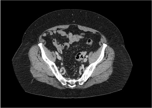Axial cut CT–pelvis: free air in ovary.