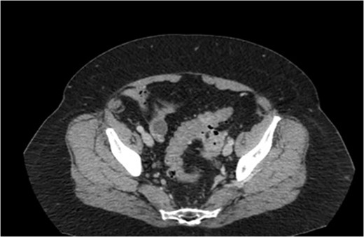 Axial cut CT–pelvis: colo-ovarian fistula.