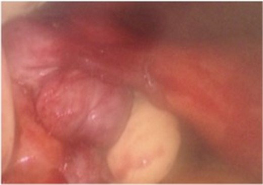 Intra-operative findings of the colo-ovarian fistula including grossly inflamed left ovary and fallopian tube.