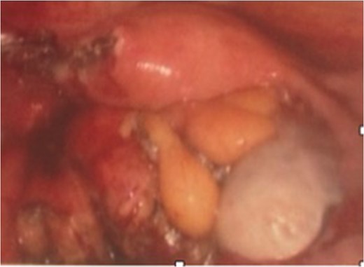 Post-resection photograph of the left portion of the uterus.