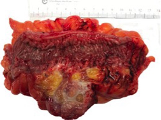 Gross photograph showing colonic diverticulum extending into pericolonic fat and forming a fistula to the underlying ovarian tissue.