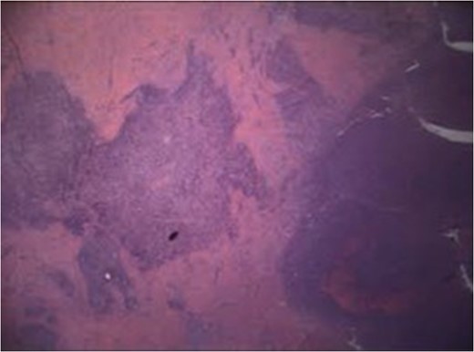 H&E slide, ×20 magnification. Fistula tract (left) lined by granulation tissue and inflammatory cells extending into ovarian stroma (right).